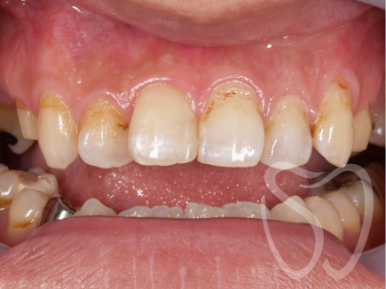 虫歯治療(右上１のみ処置後)