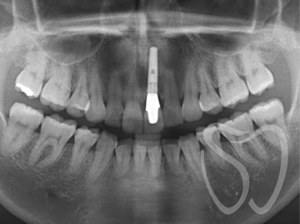 インプラント最終補綴後のレントゲン
