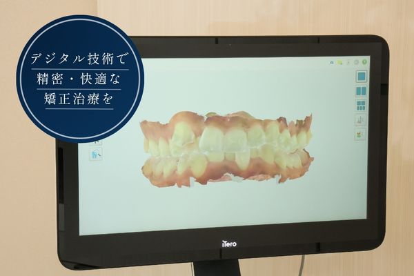 iTeroによる診断